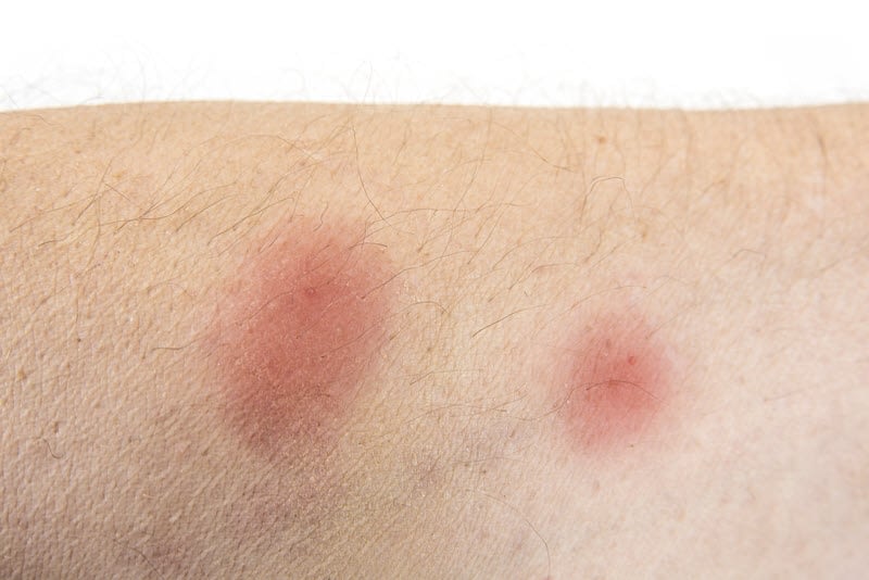 Photo of bed bug bites on the arm