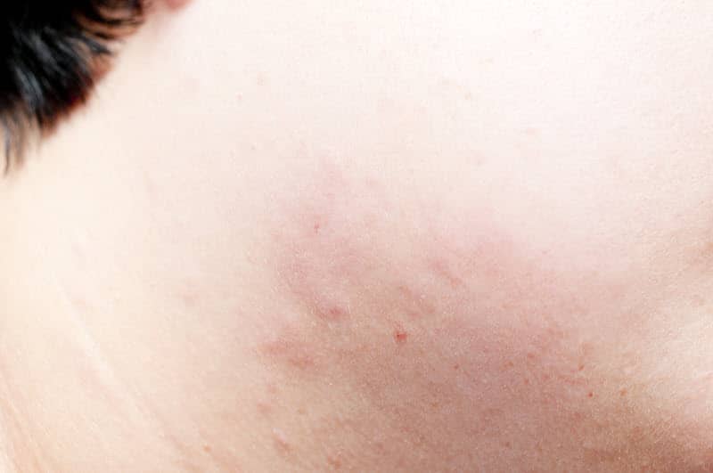 Photo of bed bug bites on the face